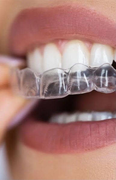 Paciente colocando alinhador transparente sobre os dentes superiores